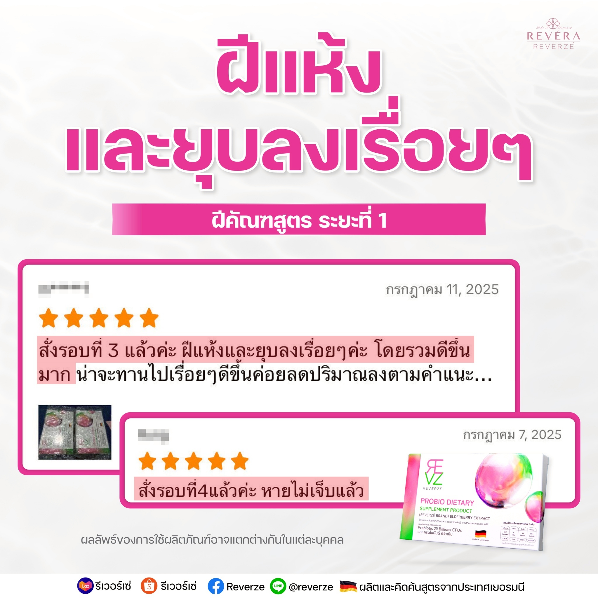 ฝีแห้ง และยุบลงเรื่อยๆ ดีขึ้นมาก ไม่เจ็บแล้ว…(รีวิวลูกค้าจริงกับ ฝีคัณฑสูตรระยะเฉียบพลัน ระยะที่ 1)