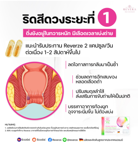 รู้อาการให้ทัน เพื่อป้องกัน “โรคริดสีดวงระยะที่ 1”