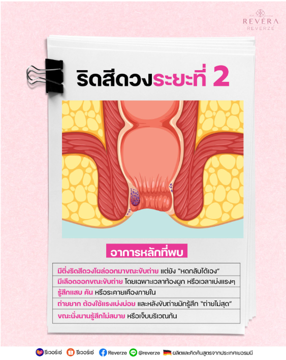 รู้ให้ทัน บรรเทาให้ไว..อย่าปล่อยทิ้งไว้ หรือชะล่าใจ กับ “ริดสีดวงระยะที่ 2!!”