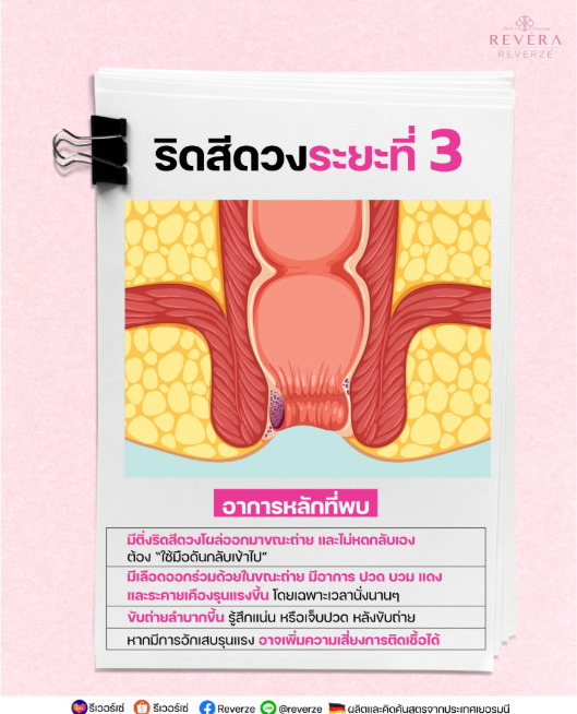 ปวดแสบบวมแดง ถ่ายปนเลืOด มีติ่งโผล่!! “โรคริดสีดวงระยะที่ 3”