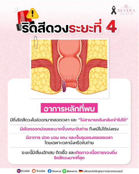 ถ่ายปนเลืOด.. ปวดบวมแดงขั้นรุนแรง! “โรคริดสีดวงระยะที่ 4” ระยะอันตรๅย ที่ไม่ควรละเลย!!