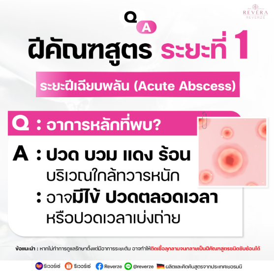 ฝีคัณฑสูตร “ระยะเฉียบพลัน”!!…ระยะเริ่มต้นที่ต้องรู้ทัน และต้องดูแลให้ถูกทาง!!
